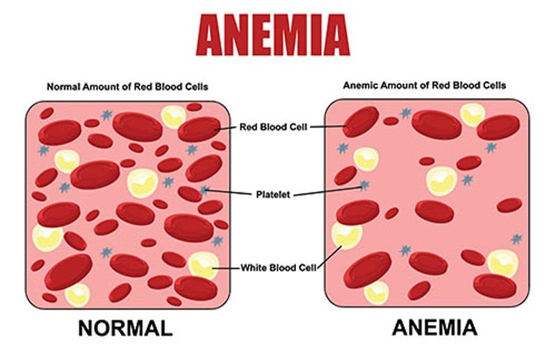 تفاوت خون طبیعی (سمت چپ) با خون آنمیک (سمت راست)