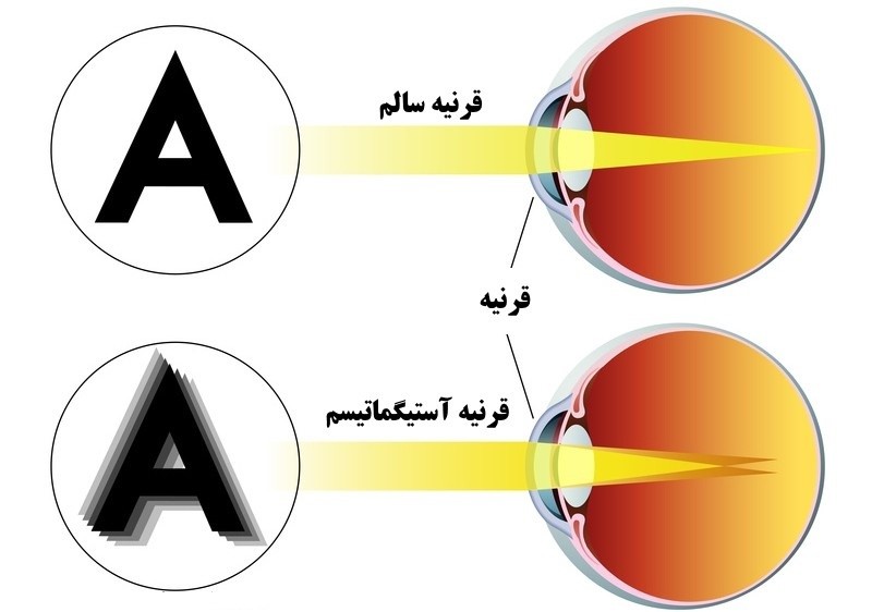 ایجاد چند کانون بینایی به علّت استیگماتیسم و تار شدن بینایی (شکل پایین)