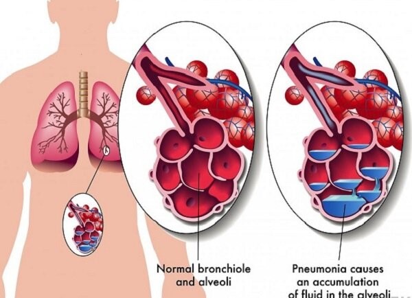 سندرم دیسترس حاد تنفسی (ARDS)